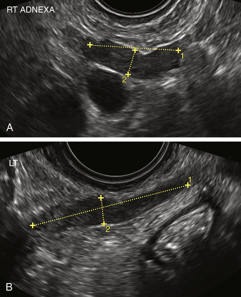 Tubo-Ovarian Abcess And Pelvic Inflammatory Disease | Clinical Gate