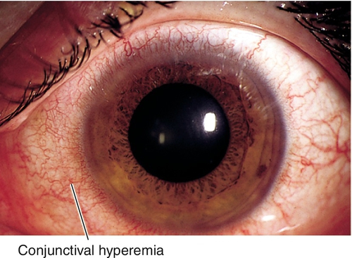 Conjunctiva And Sclera Clinical Gate