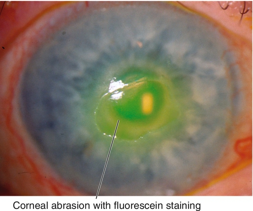 Cornea Clinical GateClinical Gate Cornea Clinical GateClinical Gate