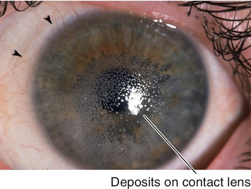 Cornea Clinical Gate