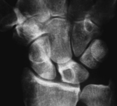 Arthroscopically Assisted Treatment Of Intraosseous Ganglions Of The Lunate Clinical Gate