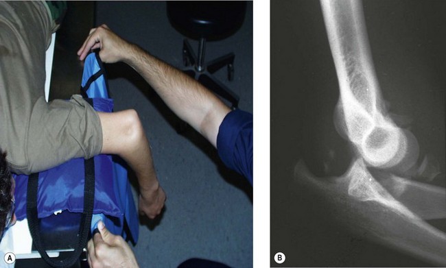 Acute Elbow Dislocations And Management | Clinical Gate