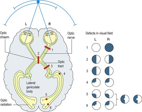 Disturbances of vision | Clinical Gate