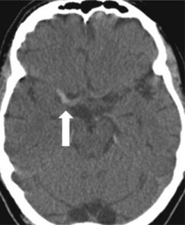 A 68-year-old woman with a left hemiplegia following a conscious ...