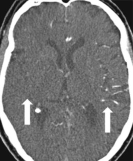 A 68-year-old woman with a left hemiplegia following a conscious ...