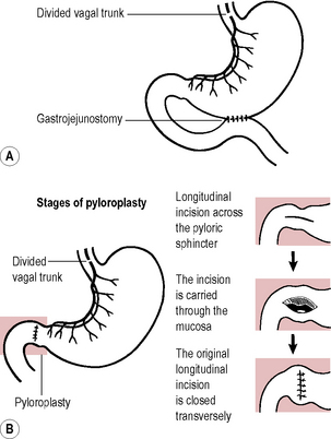 vagotomy and pyloroplasty