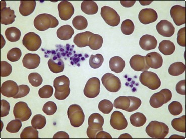 Thrombocytopenia Clinical GateClinical Gate
