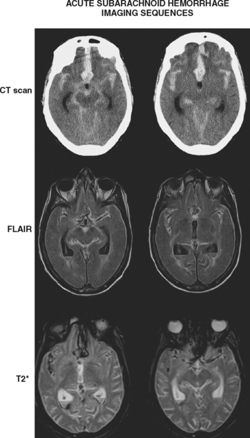 Subarachnoid Hemorrhage Clinical Gate