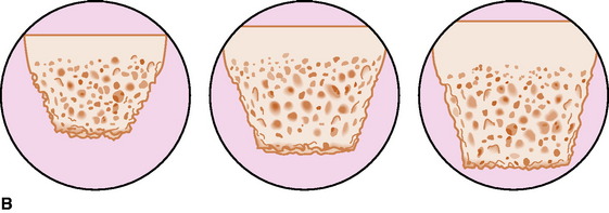 Biomechanics Of Intratunnel Anterior Cruciate Ligament Graft Fixation 