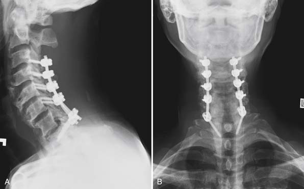 Subaxial Cervical And Upper Thoracic Spine Fractures In The Elderly Clinical Gate 1288