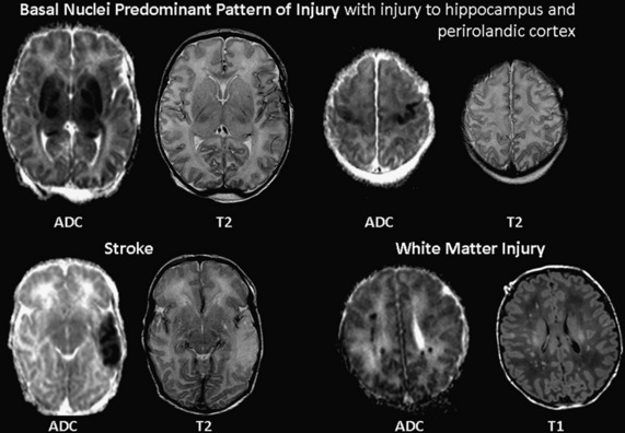 Hypoxic Ischemic Brain Injury In The Term Newborn Clinical Gate
