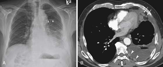 Pleural Tumors | Clinical Gate