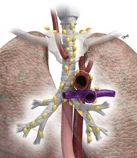 Pleural Tumors | Clinical Gate