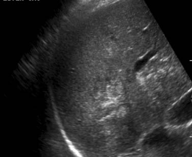 Cholangiocarcinoma | Clinical Gate