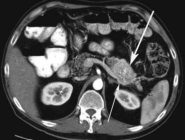 Pancreatic Neuroendocrine Tumors | Clinical Gate