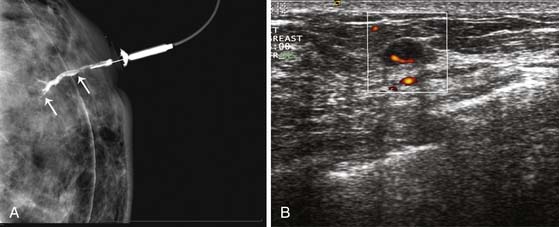 Breast Cancer  Clinical Gate