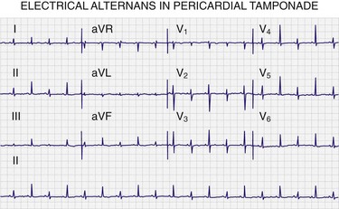 Pericardiocentesis Clinical Gate
