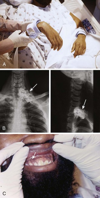 Foreign Body Removal | Clinical Gate