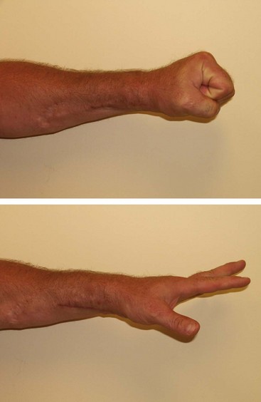 20: Tendon Transfers For Radial Nerve Palsy | Clinical Gate