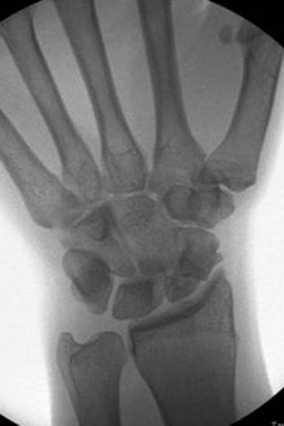 69: Vascularized Bone Grafting For Scaphoid Nonunion | Clinical Gate