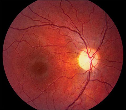 Optic Nerve Hypoplasia: A Major Cause of Childhood Blindness - Vision  Science Academy