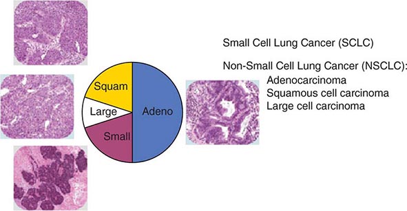 Neoplasms Of The Lung Clinical Gate