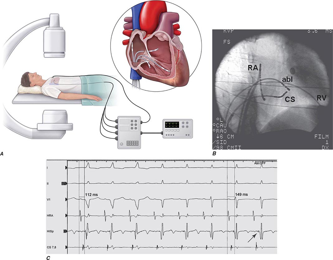 Atlas Of Electrocardiography | Clinical Gate