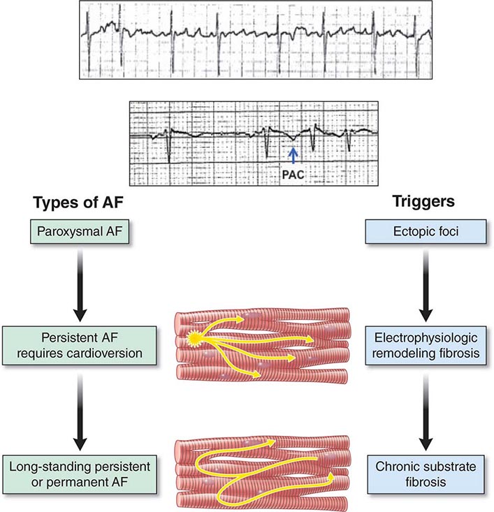 Atlas Of Cardiac Arrhythmias Clinical Gate