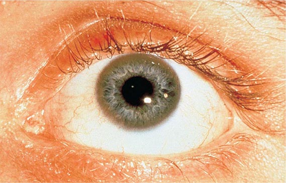 hemochromatosis eye