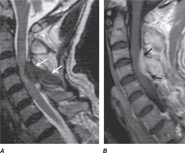 Diseases of the Spinal Cord | Clinical Gate