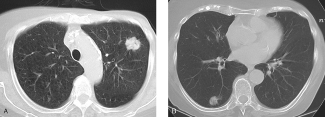 Detection of Breast Cancer: Screening of Asymptomatic Patients