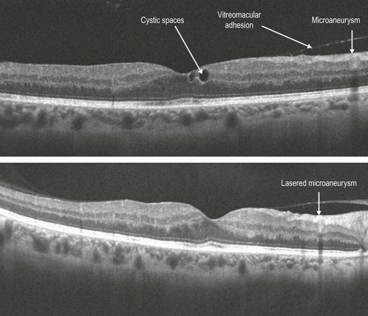 Non Proliferative Diabetic Retinopathy Clinical GateClinical Gate Non Proliferative Diabetic Retinopathy Clinical GateClinical Gate