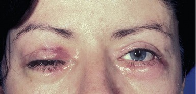 Blepharoplasty complications clearance