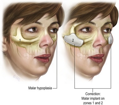 Total Facial Alloplastic Augmentation Clinical Gate