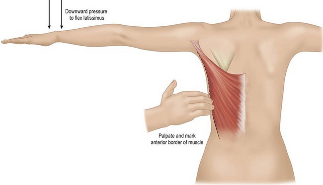 Latissimus Dorsi Flap Breast Reconstruction Clinical Gate
