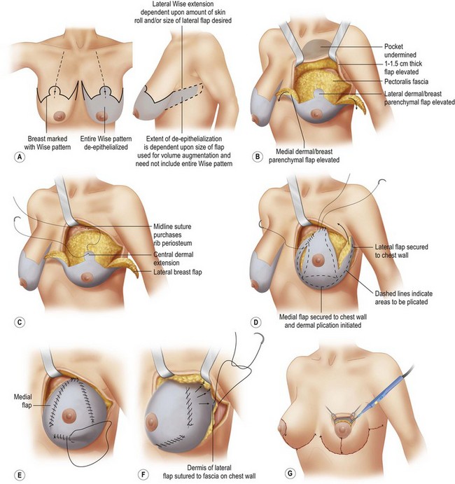 Mastopexy  Clinical Gate