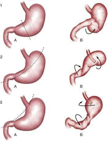 paraesophageal hernia with gastric volvulus