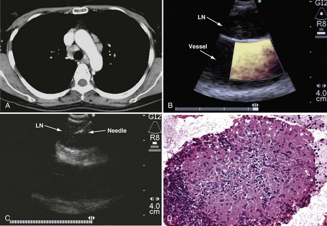 Endobronchial And Endoesophageal Ultrasound Techniques Clinical Gate