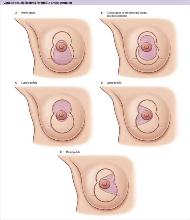 PDF) Preoperative estimation of breast resection weight in patients  undergoing inferior pedicle reduction mammoplasty: the Bilgen formula