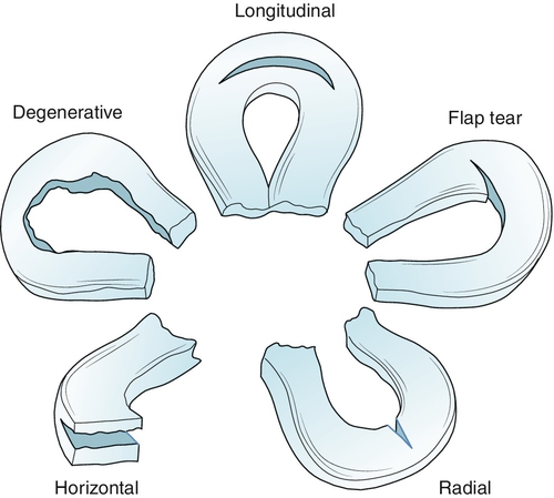 acute lateral meniscus tear icd 10