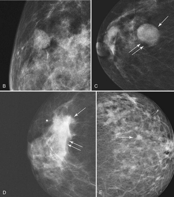 Фиброаденоматоз bi rads 2. Фиброзно кистозная мастопатия молочной железы bi-rads-4a. Молочная железа фиброаденома bi-rads 2. ACR 3 маммография что это. Bi rads 4 б маммография.