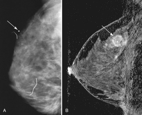 breast cancer imaging thesis