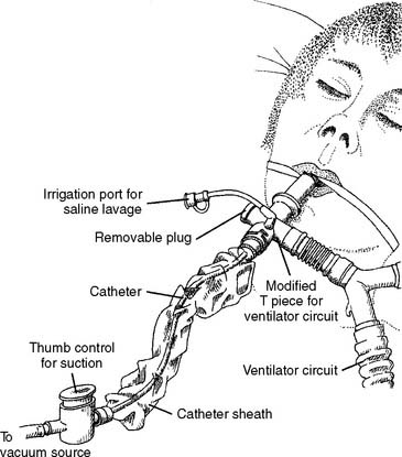 tracheostomy tube suctioning