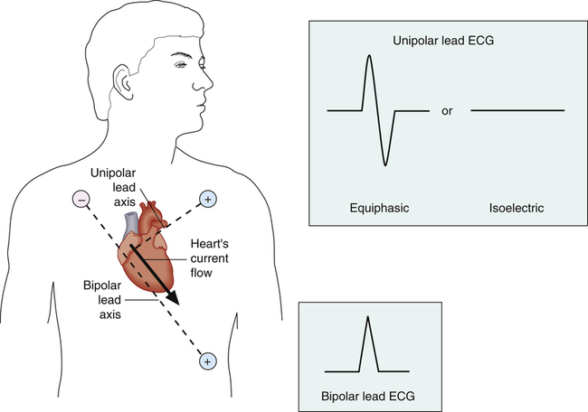 the-electrocardiogram-and-cardiac-arrhythmias-in-adults-clinical-gate