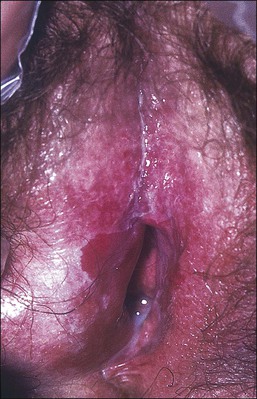 Vulvar Dermatoses and Infections