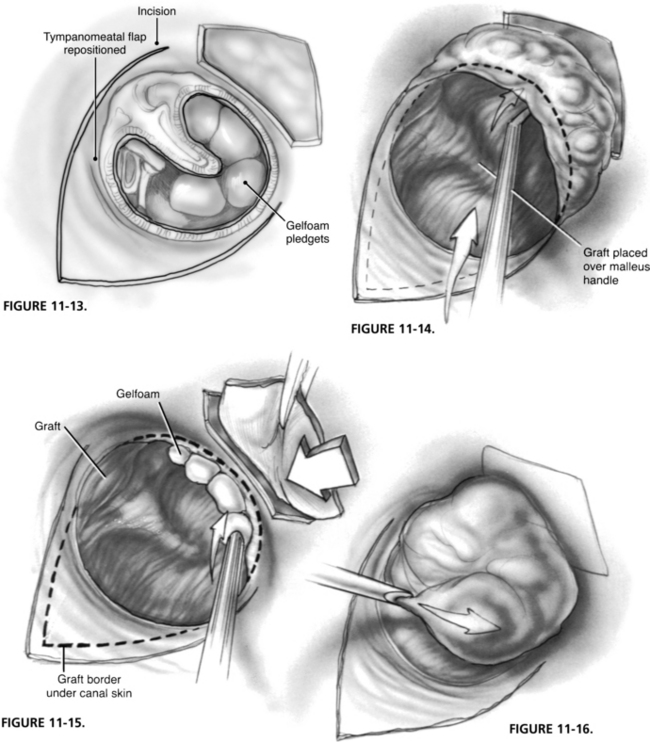 Tympanoplasty-Undersurface Graft Technique: Transcanal Approach ...