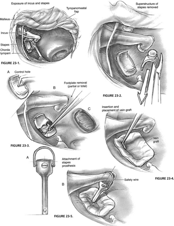 Partial Stapedectomy Clinical Gate