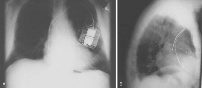 Implantable Cardioverter Defibrillators Device Technology And Implantation Techniques
