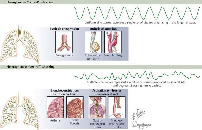 What Cause Wheezing In Infants