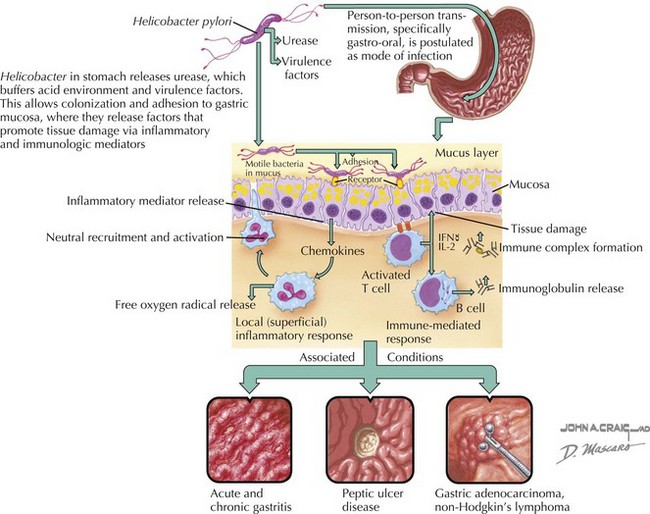 Gastritis And Gastrointestinal Bleeding Clinical Gate